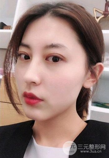 蘇州切開雙眼皮恢復(fù)果大分享，變化不止一點點