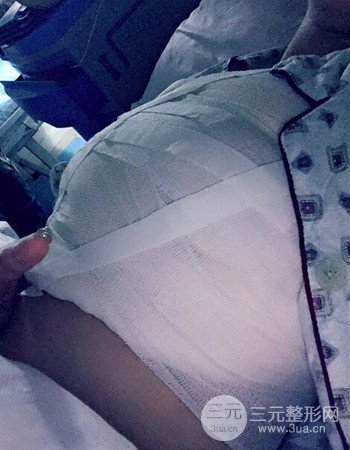 蘇州假體隆胸手術(shù)案例分享、前后對(duì)比圖分享