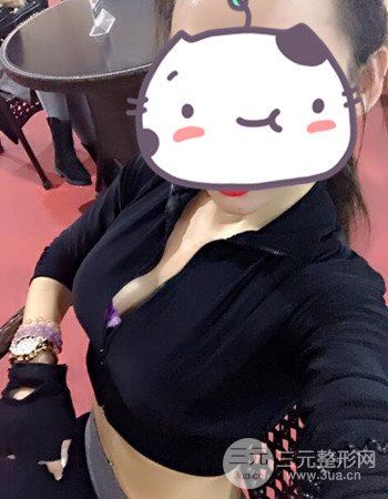 蘇州假體隆胸手術(shù)案例分享、前后對(duì)比圖分享