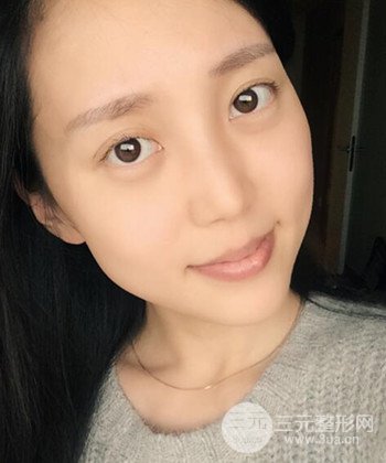 深圳內(nèi)切去眼袋+硅膠墊下巴真實案例恢復果圖