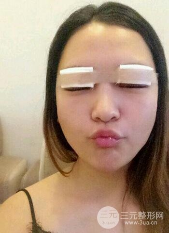 深圳雙眼皮正就內(nèi)雙小眼睛，真實(shí)案例前后對比照片
