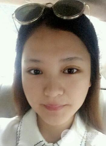 深圳雙眼皮正就內(nèi)雙小眼睛，真實(shí)案例前后對比照片