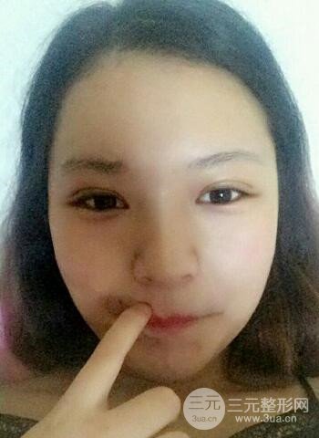 深圳雙眼皮正就內(nèi)雙小眼睛，真實(shí)案例前后對比照片