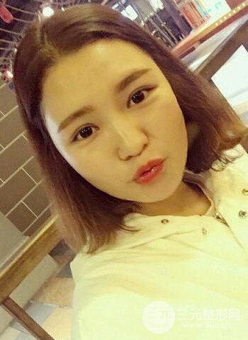 深圳雙眼皮正就內(nèi)雙小眼睛，真實(shí)案例前后對比照片