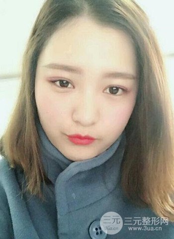 深圳雙眼皮正就內(nèi)雙小眼睛，真實(shí)案例前后對比照片