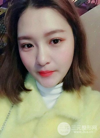 深圳雙眼皮正就內(nèi)雙小眼睛，真實(shí)案例前后對比照片