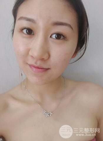 廣州隆鼻整形真實恢復期圖片，擁有精致美鼻不是夢