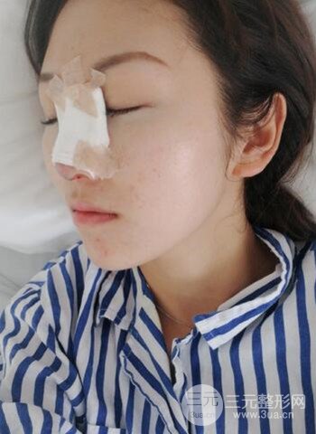 廣州隆鼻整形真實恢復期圖片，擁有精致美鼻不是夢