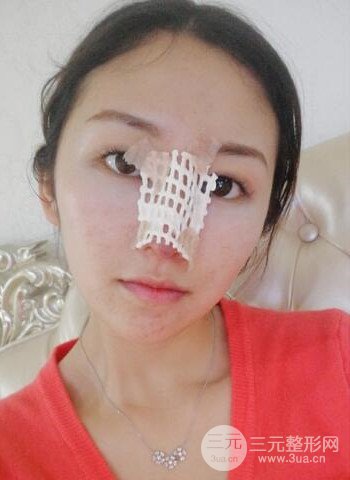廣州隆鼻整形真實恢復期圖片，擁有精致美鼻不是夢