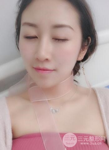 廣州隆鼻整形真實恢復期圖片，擁有精致美鼻不是夢