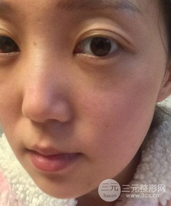 深圳內(nèi)切去眼袋+硅膠墊下巴真實案例恢復果圖