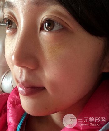 深圳內(nèi)切去眼袋+硅膠墊下巴真實案例恢復果圖