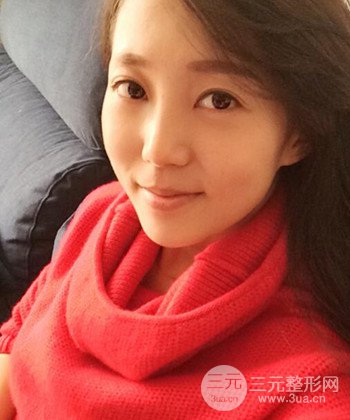 深圳內(nèi)切去眼袋+硅膠墊下巴真實案例恢復果圖