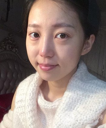 深圳內(nèi)切去眼袋+硅膠墊下巴真實案例恢復果圖