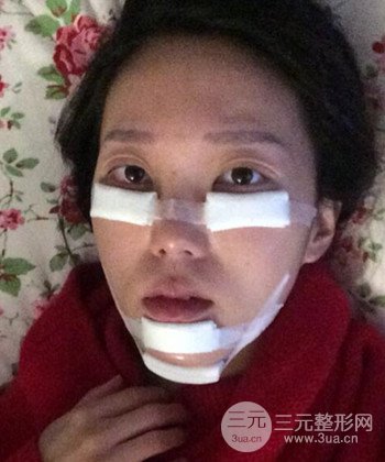 深圳內(nèi)切去眼袋+硅膠墊下巴真實案例恢復果圖