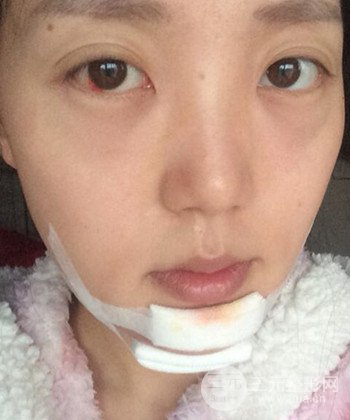 深圳內(nèi)切去眼袋+硅膠墊下巴真實案例恢復果圖