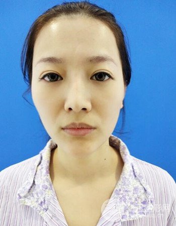 廣州隆鼻整形+全臉自體脂肪填充真人案例果分享