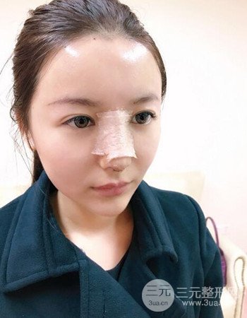 廣州隆鼻整形+全臉自體脂肪填充真人案例果分享