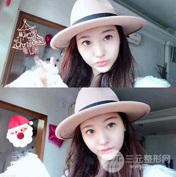 廣州隆鼻整形+全臉自體脂肪填充真人案例果分享