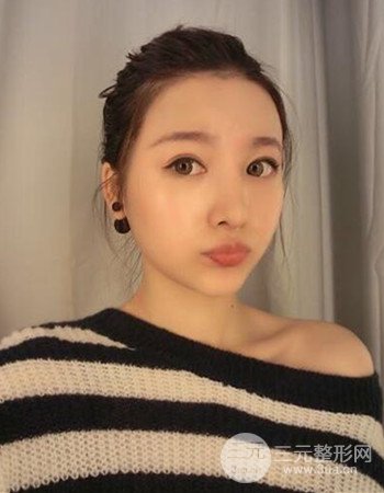 廣州隆鼻整形+全臉自體脂肪填充真人案例果分享