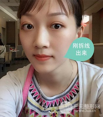 北京雙眼皮失敗修復手術(shù)日記分享，附上前后對比照片