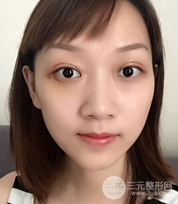 北京雙眼皮失敗修復手術(shù)日記分享，附上前后對比照片