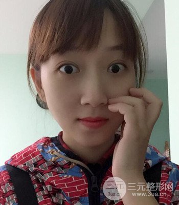 北京雙眼皮失敗修復手術(shù)日記分享，附上前后對比照片