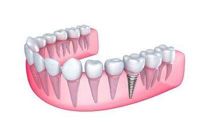 北京種植牙費(fèi)用貴不貴
