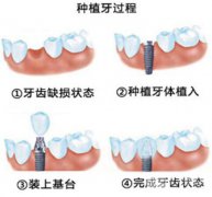 杭州種植牙價(jià)格