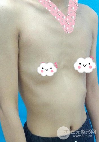 深圳假體隆胸讓平胸妹華麗變身，手術(shù)果分享