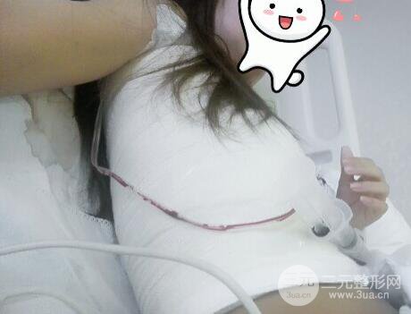 深圳假體隆胸讓平胸妹華麗變身，手術(shù)果分享