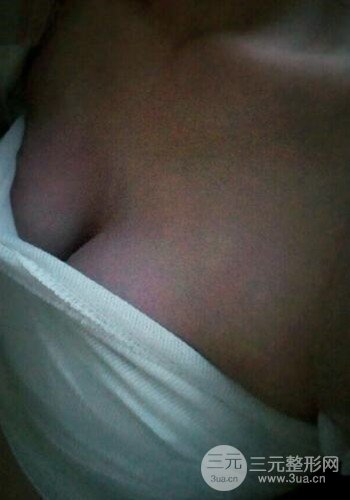 深圳假體隆胸讓平胸妹華麗變身，手術(shù)果分享