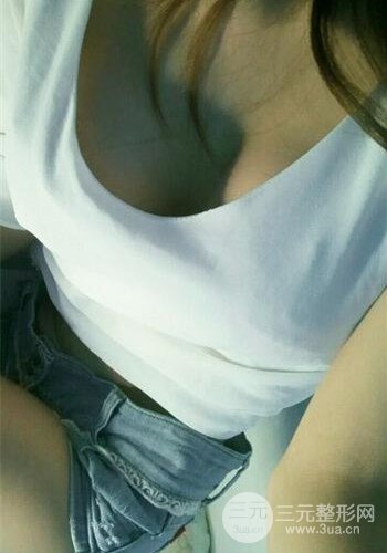 深圳假體隆胸讓平胸妹華麗變身，手術(shù)果分享