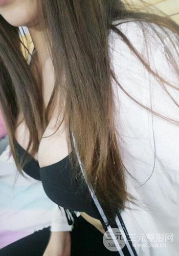 深圳假體隆胸讓平胸妹華麗變身，手術(shù)果分享