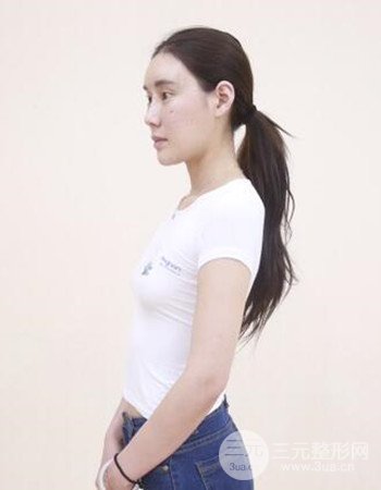 上海假體隆胸真人日記手術(shù)果分享,從A到D不是夢