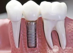廣州種植牙價(jià)格?廣州種植牙多少錢?