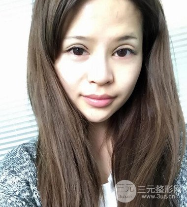 上海雙眼皮手術(shù)真人案例恢復(fù)過程分享