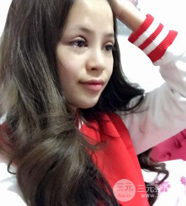 上海雙眼皮手術(shù)真人案例恢復(fù)過程分享