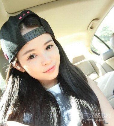 上海雙眼皮手術(shù)真人案例恢復(fù)過程分享