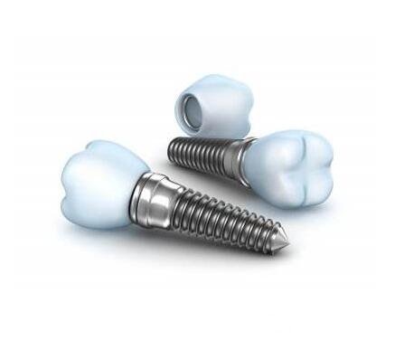 廣州種植牙價格是多少