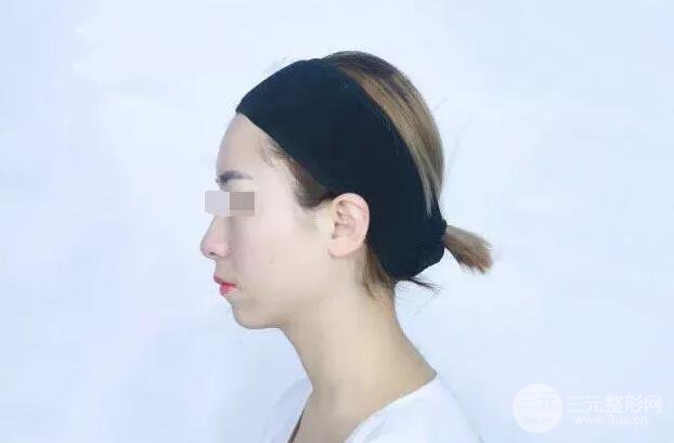 瑞蘭隆鼻多少錢(qián) 瑞蘭隆鼻真實(shí)一個(gè)月恢復(fù)前后對(duì)比圖案例