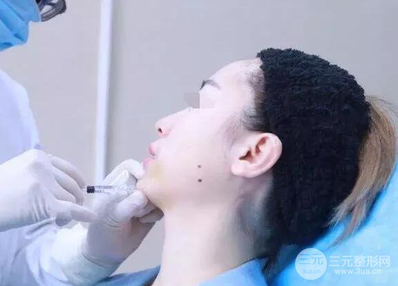 瑞蘭隆鼻多少錢(qián) 瑞蘭隆鼻真實(shí)一個(gè)月恢復(fù)前后對(duì)比圖案例