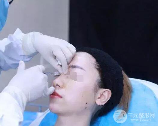 瑞蘭隆鼻多少錢(qián) 瑞蘭隆鼻真實(shí)一個(gè)月恢復(fù)前后對(duì)比圖案例