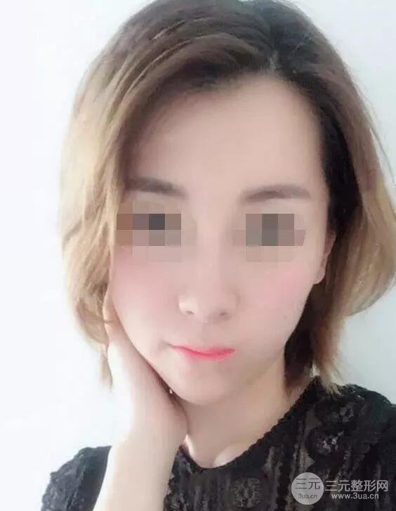 瑞蘭隆鼻多少錢(qián) 瑞蘭隆鼻真實(shí)一個(gè)月恢復(fù)前后對(duì)比圖案例