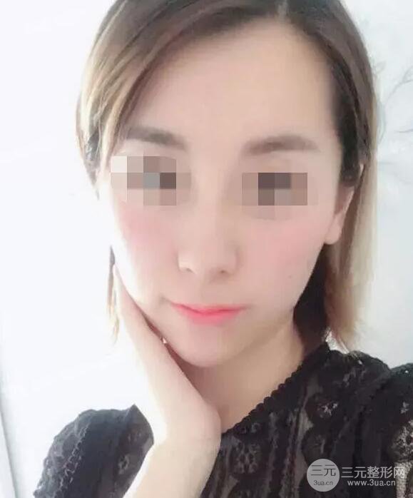 瑞蘭隆鼻多少錢(qián) 瑞蘭隆鼻真實(shí)一個(gè)月恢復(fù)前后對(duì)比圖案例