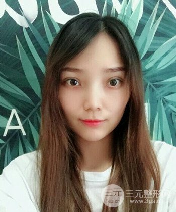 雙眼皮失敗修復(fù)手術(shù)日記分享，改變雙眼皮不對稱