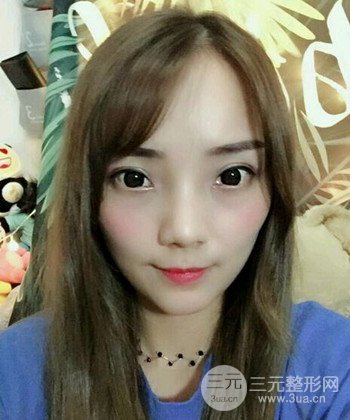 雙眼皮失敗修復(fù)手術(shù)日記分享，改變雙眼皮不對稱