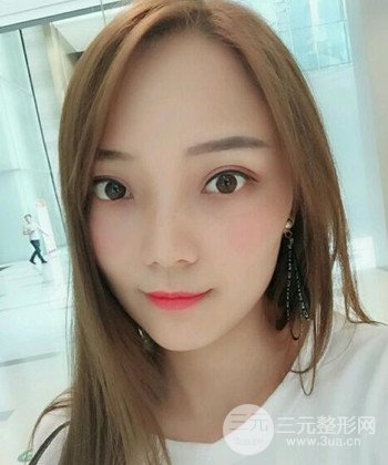 雙眼皮失敗修復(fù)手術(shù)日記分享，改變雙眼皮不對稱