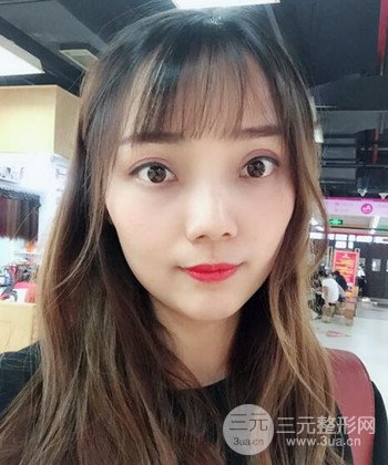 雙眼皮失敗修復(fù)手術(shù)日記分享，改變雙眼皮不對稱