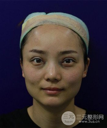 雙眼皮失敗修復(fù)手術(shù)日記分享，改變雙眼皮不對稱